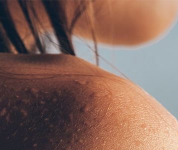 3 Simple Steps to Ease Eczema